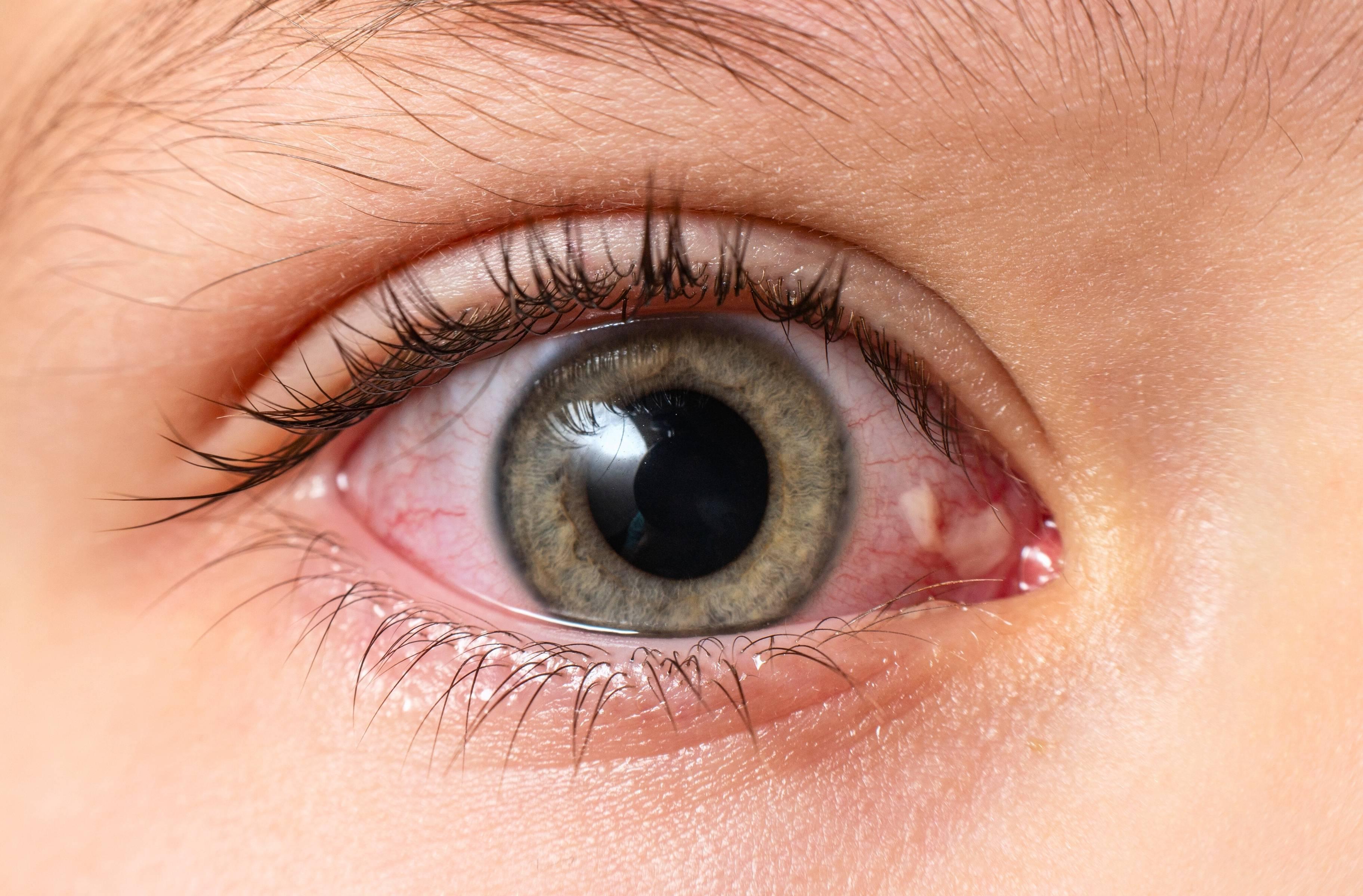 Sudden Eye Redness: When Is It Serious & When Should You See a Doctor?