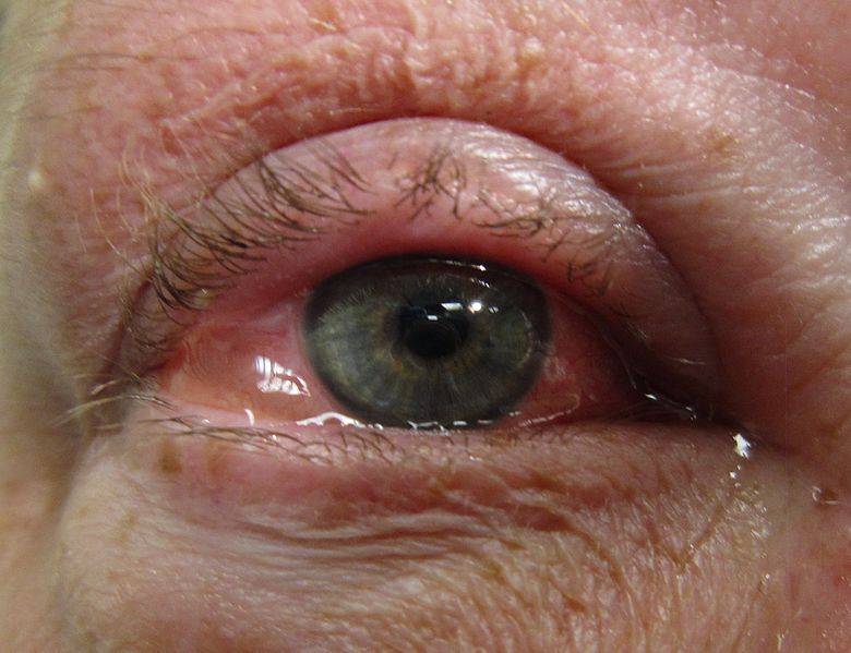 Allergic Conjunctivitis – Causes, Symptoms & Best Eye Allergy Treatment