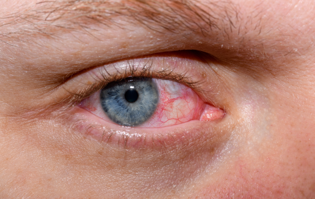 Dry Eyes Treatment in Hyderabad – Causes, Symptoms & Expert Relief