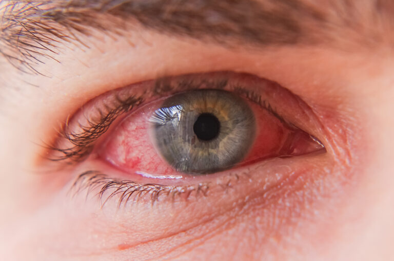 Viral Conjunctivitis (Pink Eye) – Symptoms, Causes & Treatment