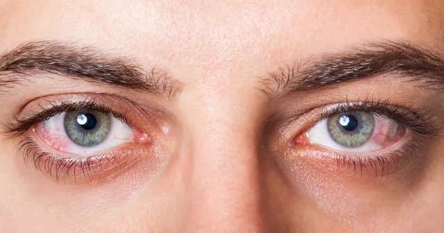 Hypertensive Retinopathy – How High Blood Pressure Affects Your Eyes